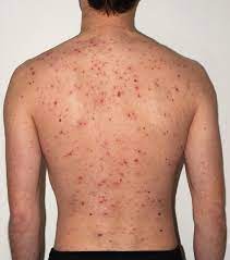 Chicken pox