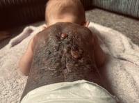 Plymouth Mum speaks out over rare birthmark