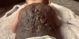 Plymouth Mum speaks out over rare birthmark