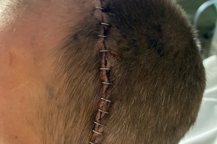 Paul Welsh-Dalton, in hospital. // A man had a tumour the size of a kiwi removed from his brain all whilst awake and playing the guitar. Paul Welsh-Dalton underwent surgery to remove his oligodendroglioma  a rare type of malignant brain tumour  on March 28. A sudden seizure at home after having suffered with aphasia and headaches meant Paul was admitted to hospital three weeks prior where doctors discovered the mass. During the five-hour craniotomy surgeons removed 98 per cent of the four-centimetre tumour  with Paul playing music on his guitar to help gauge if Pauls brains abilities were being compromised.  